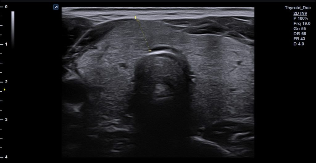 υπέρηχος θυροειδούς αδένα