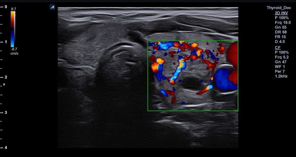 υπέρηχος θυροειδούς αδένα